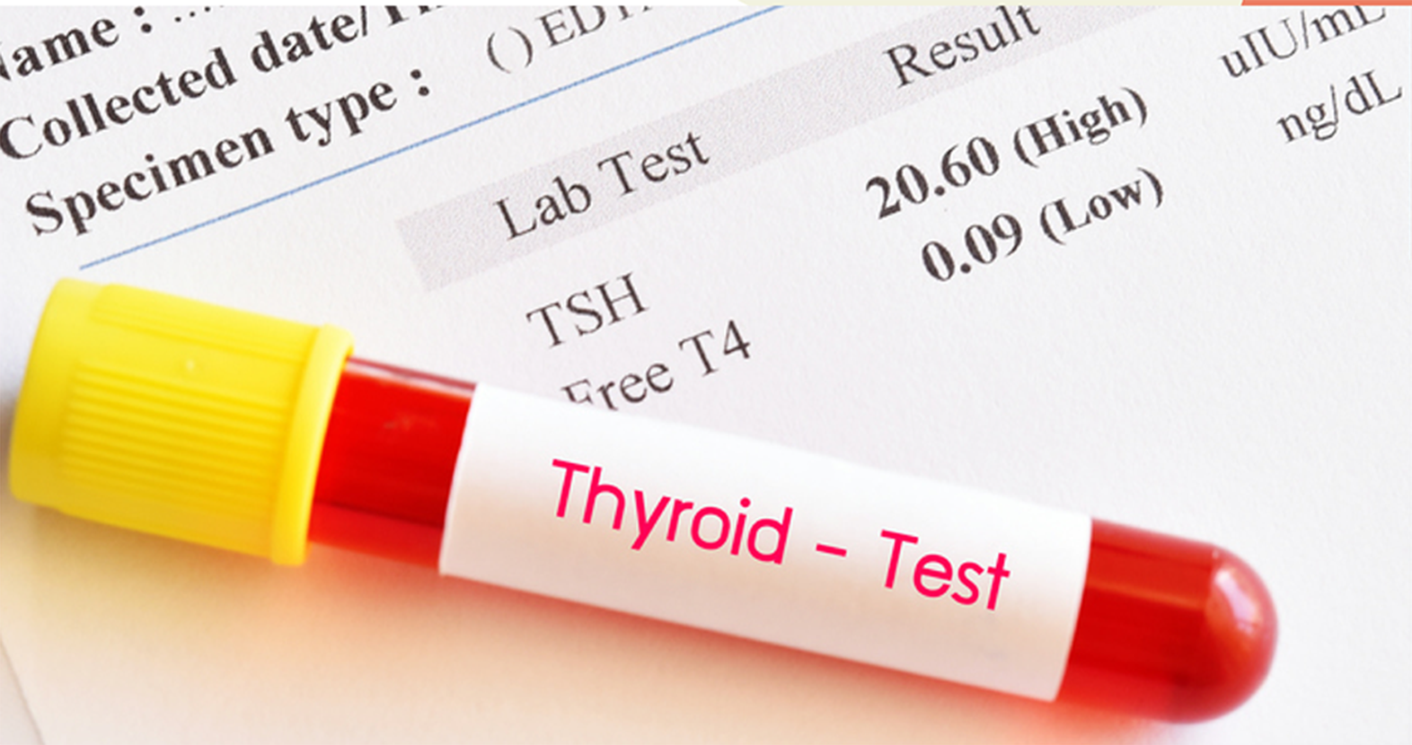 Image showing testing tube for thyroid placed on a paper showing patient report 